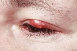 Eyelash Extension Injury
