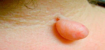 Skin Tag Removal Clearfield